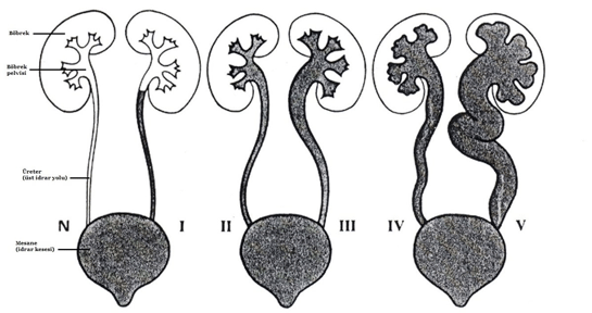 Böbrek Reflü Belirtileri ve Tedavisi