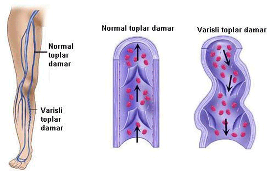 Damar Reflüsü Belirtileri ve Tedavisi