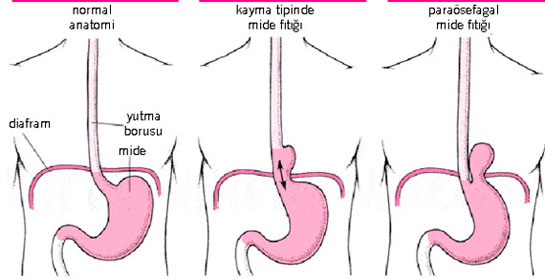 Reflü Belirtileri Reflü Tipik ve Atipik Belirtileri