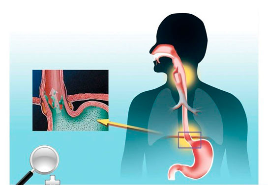 Reflü Diyeti Reflü Hastaları İçin Diyet