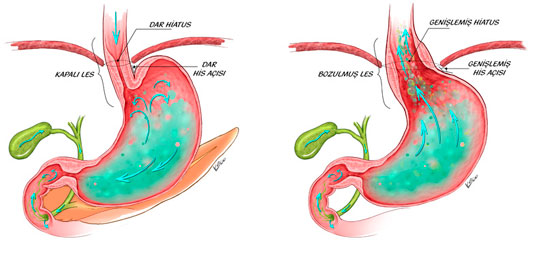 Reflü Hastalığı Belirtileri ve Tedavisi