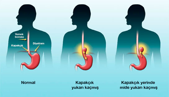 Reflüye Ne İyi Gelir?
