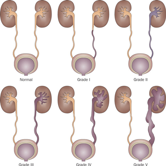 Vezikoüreteral Reflü Belirtileri ve Tedavisi